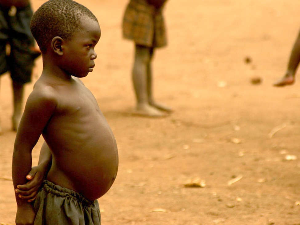 Kondisi anak anak Somalia yang menderita busung lapar