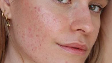 Acne. Sumber Foto: Pinterest