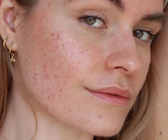 Acne. Sumber Foto: Pinterest