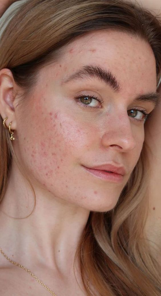 Acne. Sumber Foto: Pinterest